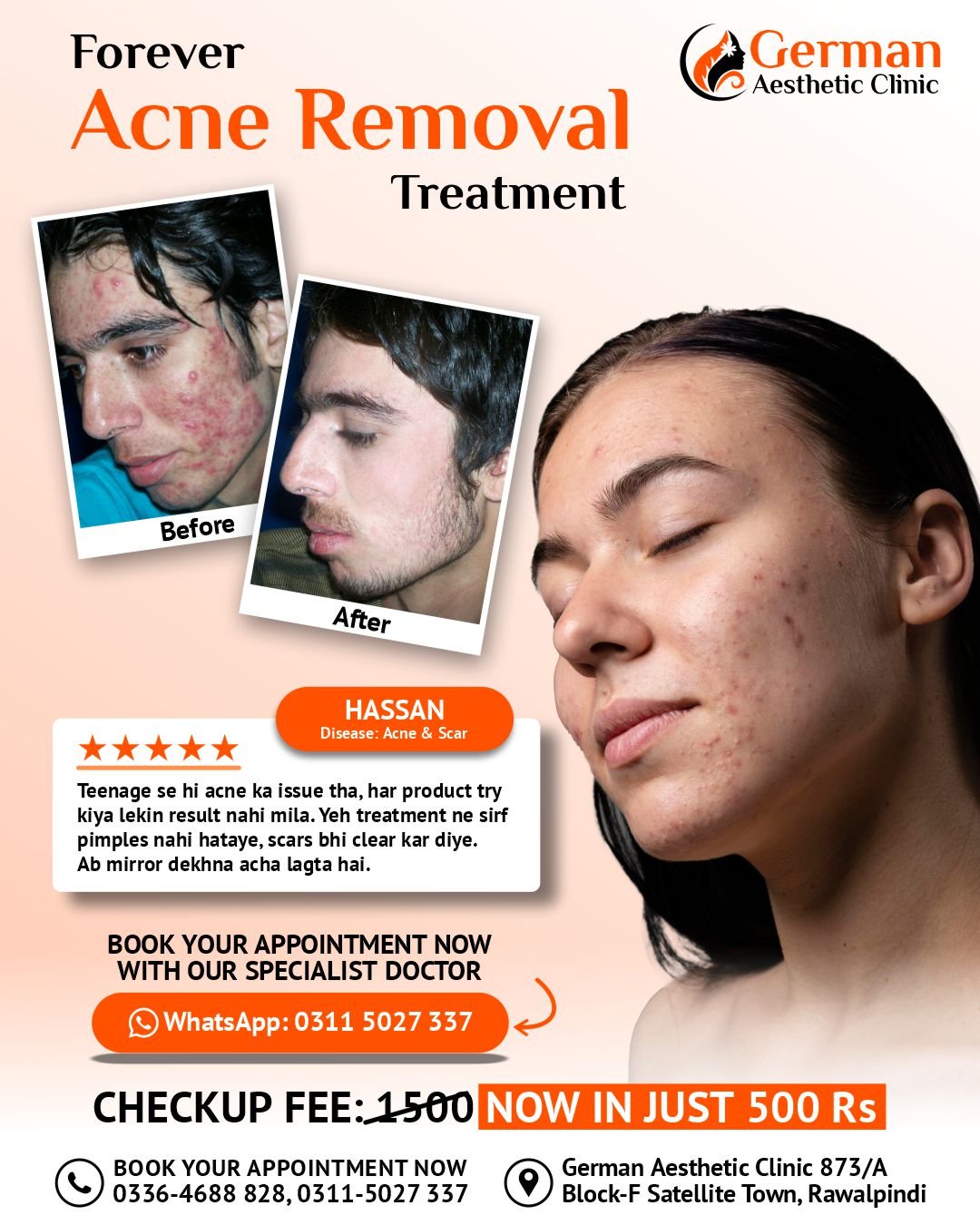 Forever Acne Treatment